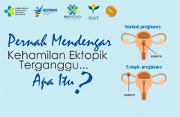 Pernah Mendengar Kehamilan Ektopik Terganggu? Apa Itu?