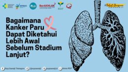 Bagaimana Kanker Paru Dapat Diketahui Lebih Awal Sebelum Stadium Lanjut?