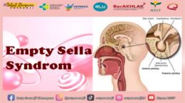 Empty Sella Syndrome