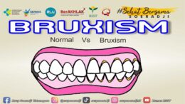 Yuk Mengenal Bruxism Lebih Dalam Mulai dari Penyebab, Gejala, Hingga Penanganan